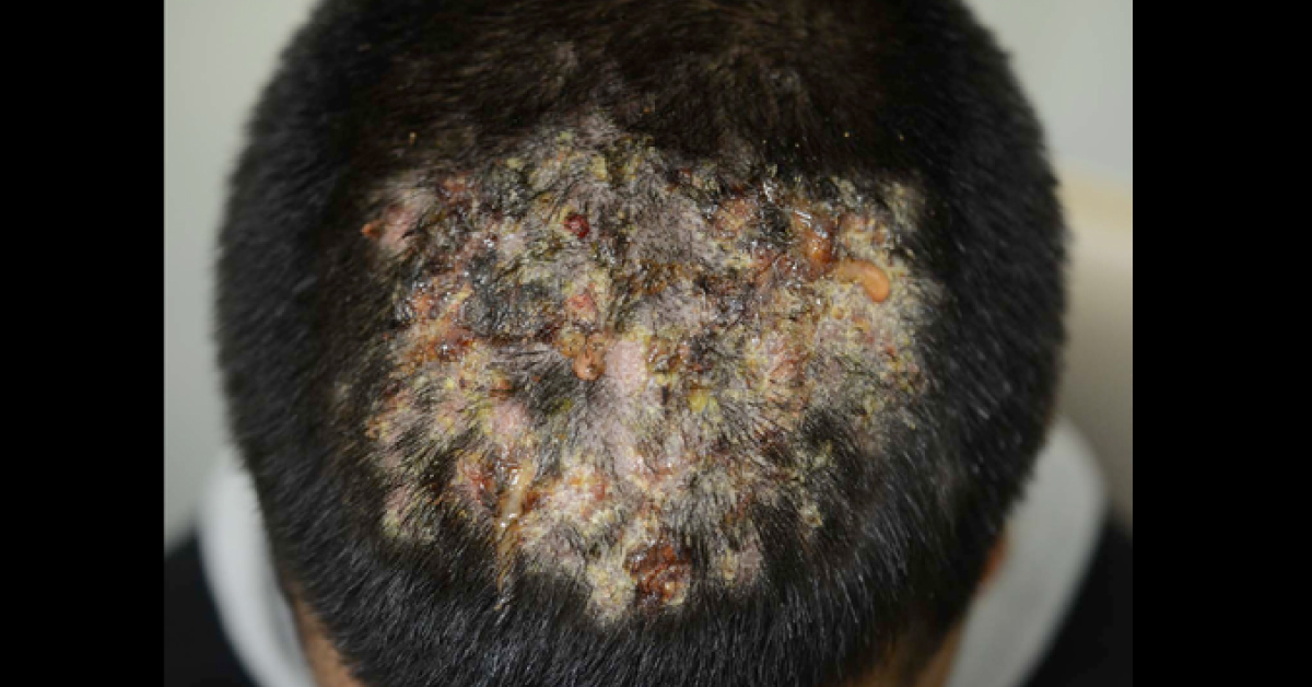 Recognize The Infection